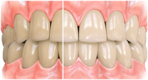 3d image of teeth showing stain removal using opalescence whitening toothpaste