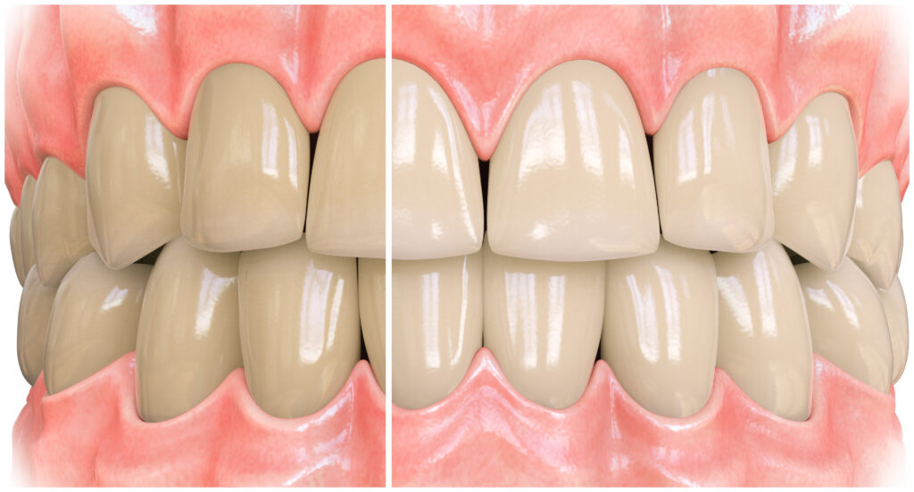 3d image of teeth showing stain removal using opalescence whitening toothpaste 3d image of teeth showing stain removal using opalescence whitening toothpaste